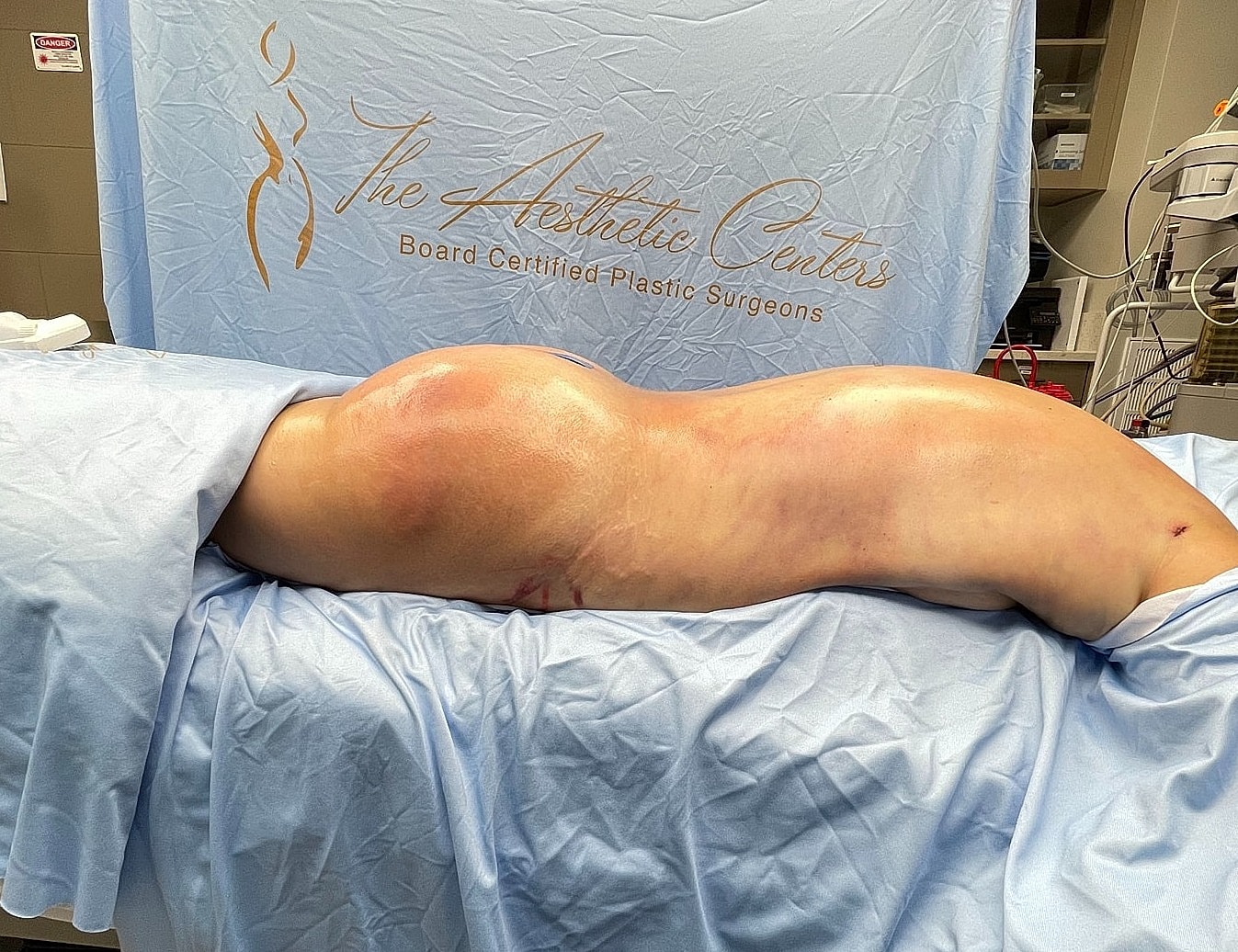 Post-surgical recovery in a medical setting.