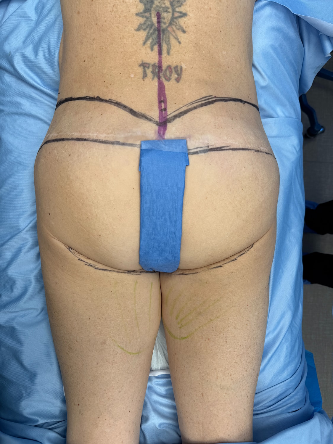 Patient's back with markings for a procedure.