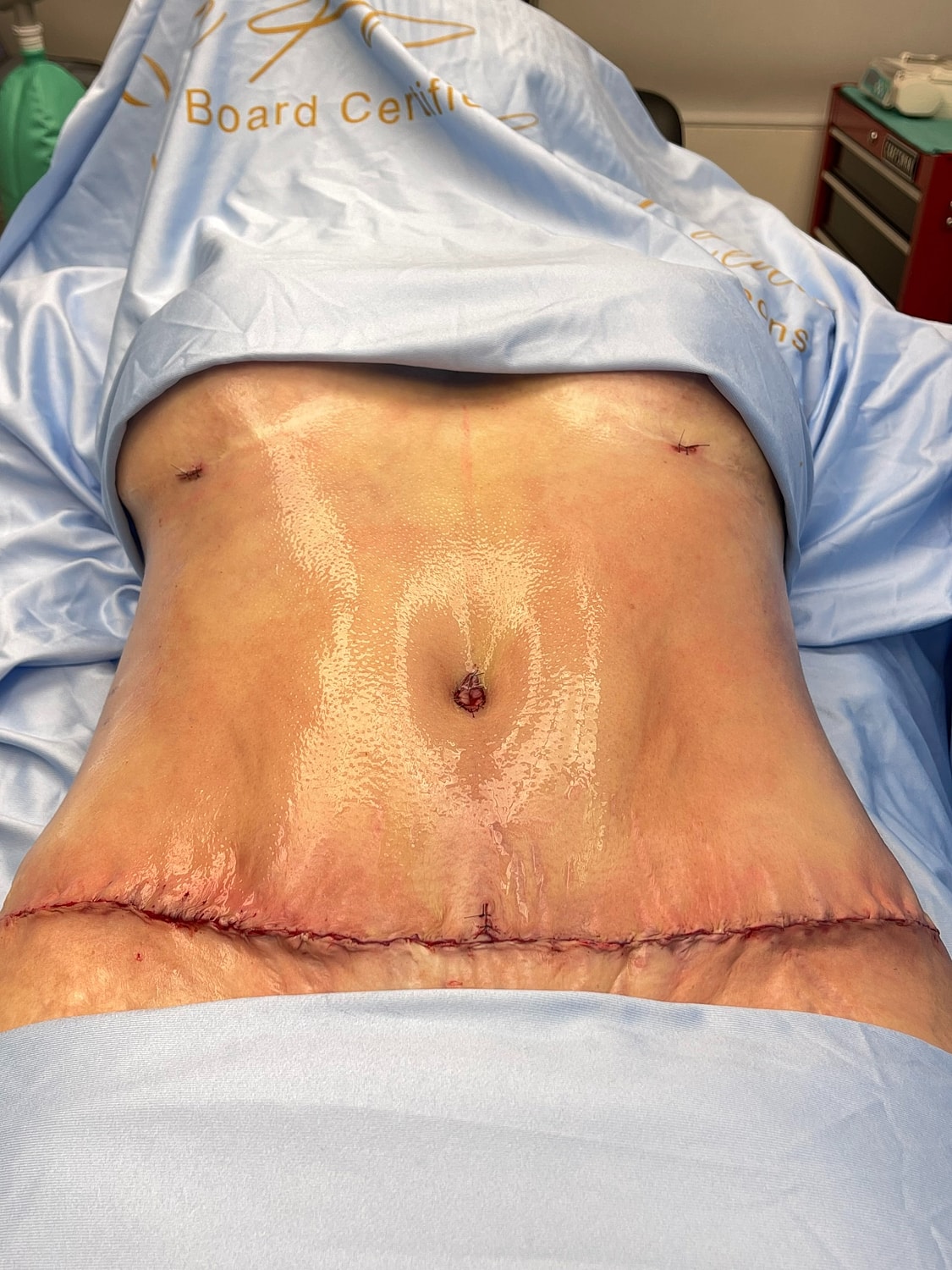 Post-surgical abdominal incision on patient.