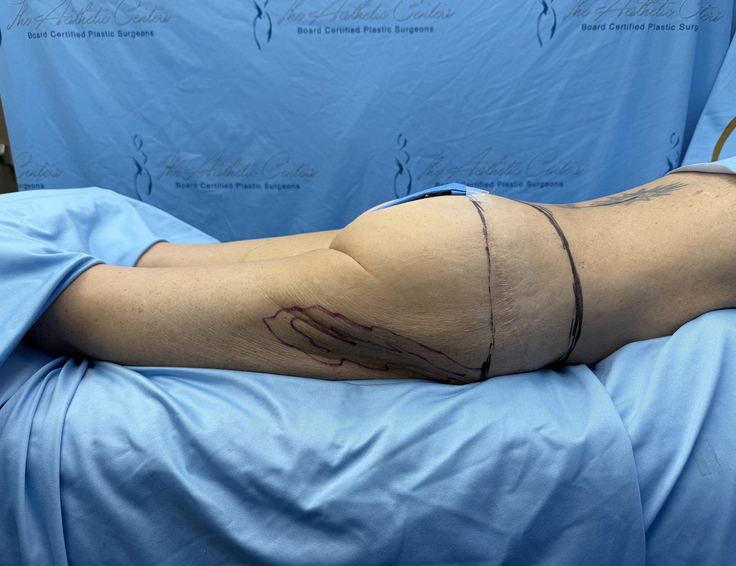 Surgical markings on patient’s arm during procedure.