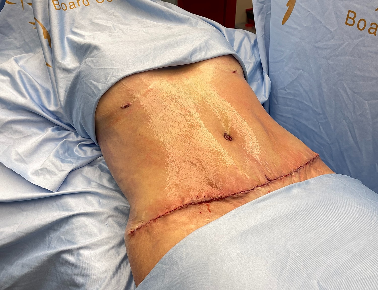 Surgical abdomen with healing incision and sutures.