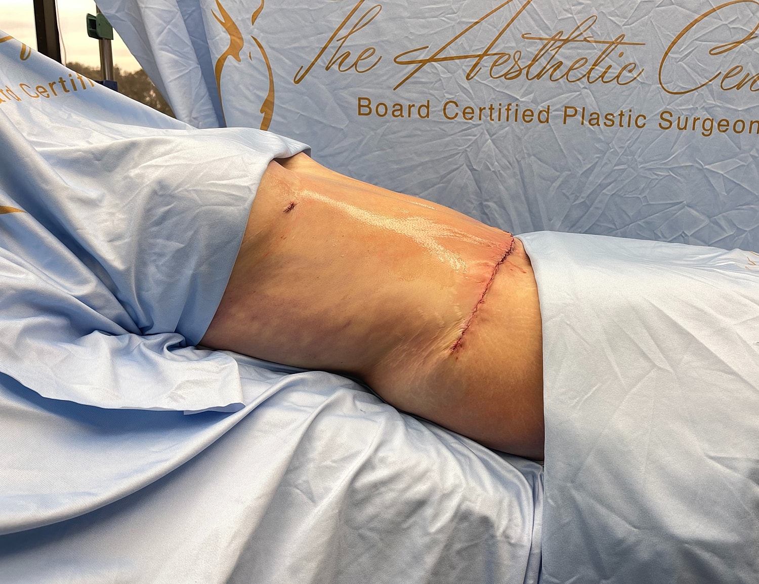 Post-surgery abdominal incision on patient’s side.