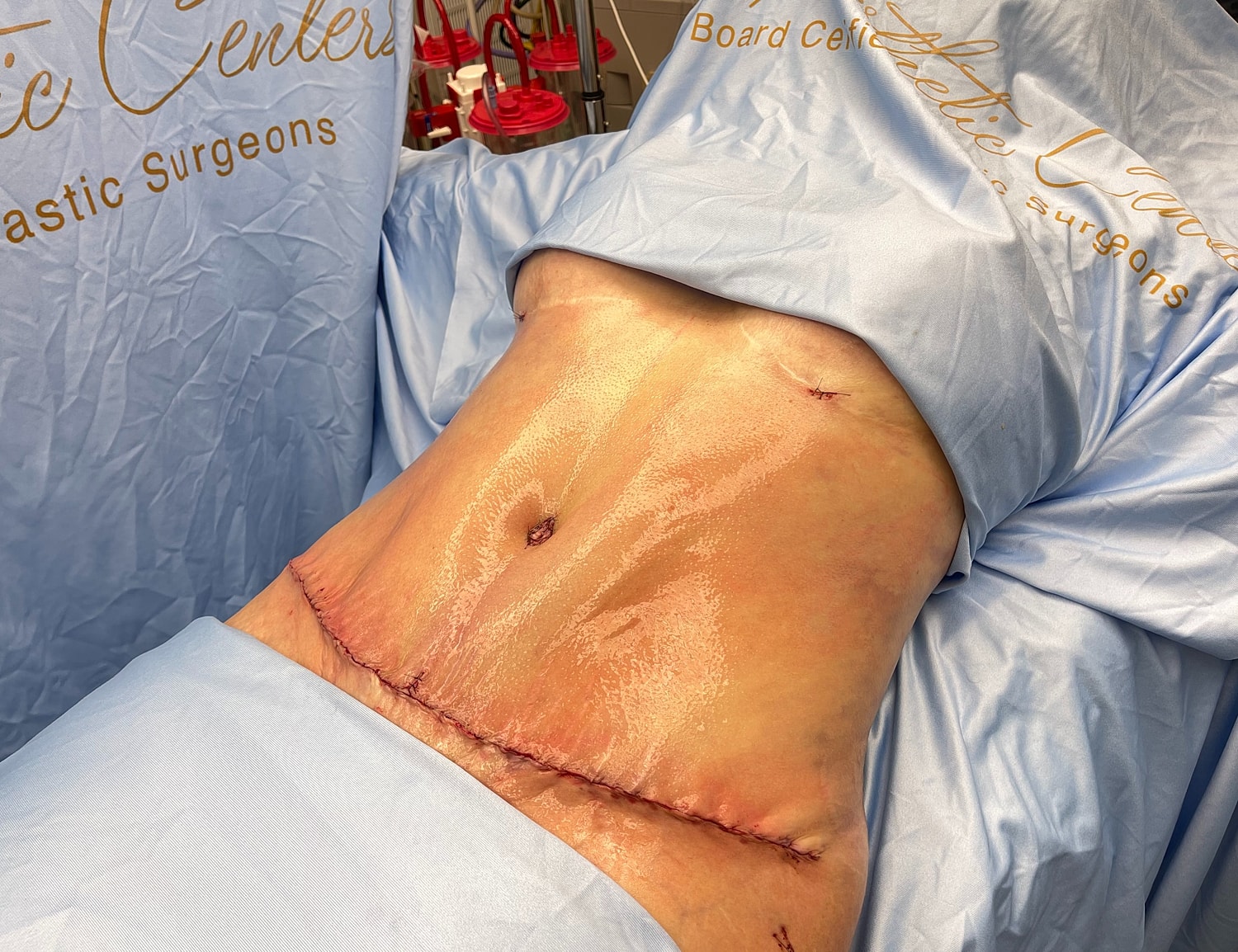 Surgical abdomen with stitches post-operation.