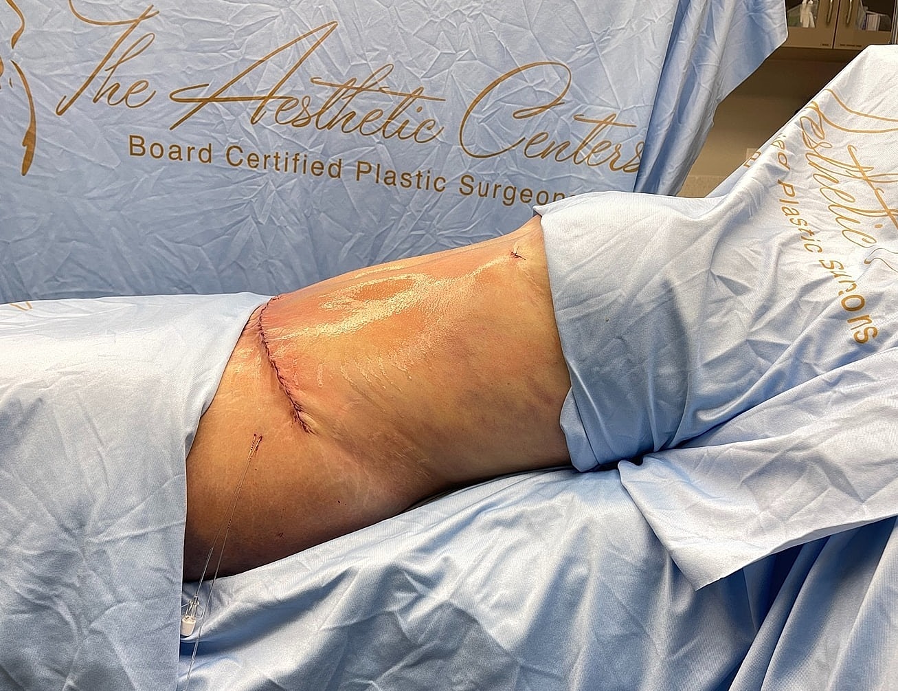 Post-surgery recovery image with medical drapes.