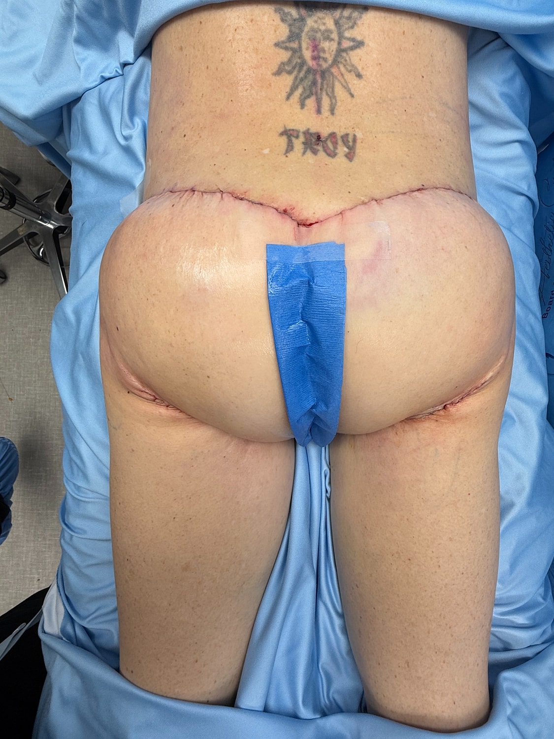 Post-surgery view of stitches on rear end.