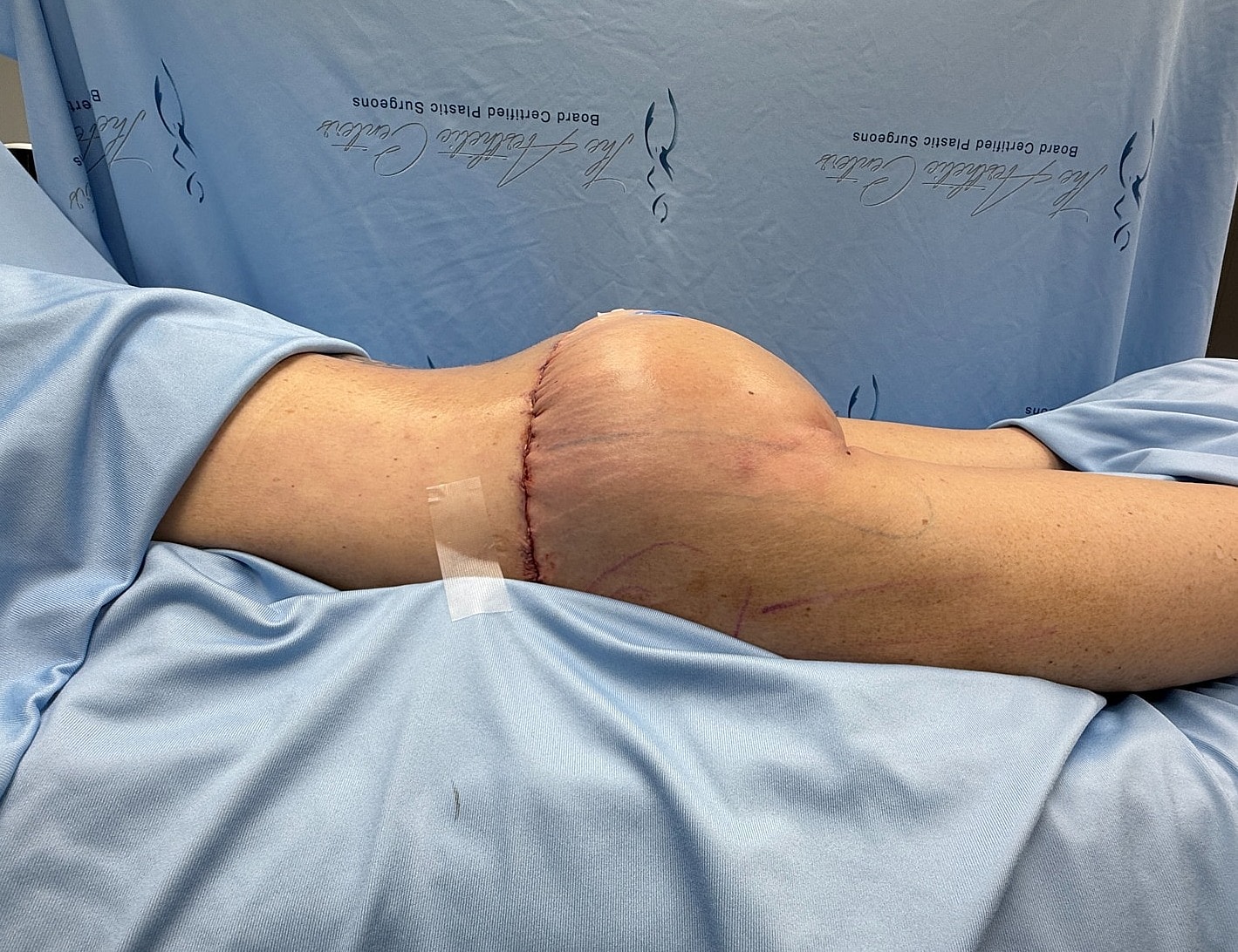 Post-surgery knee with visible incision line.