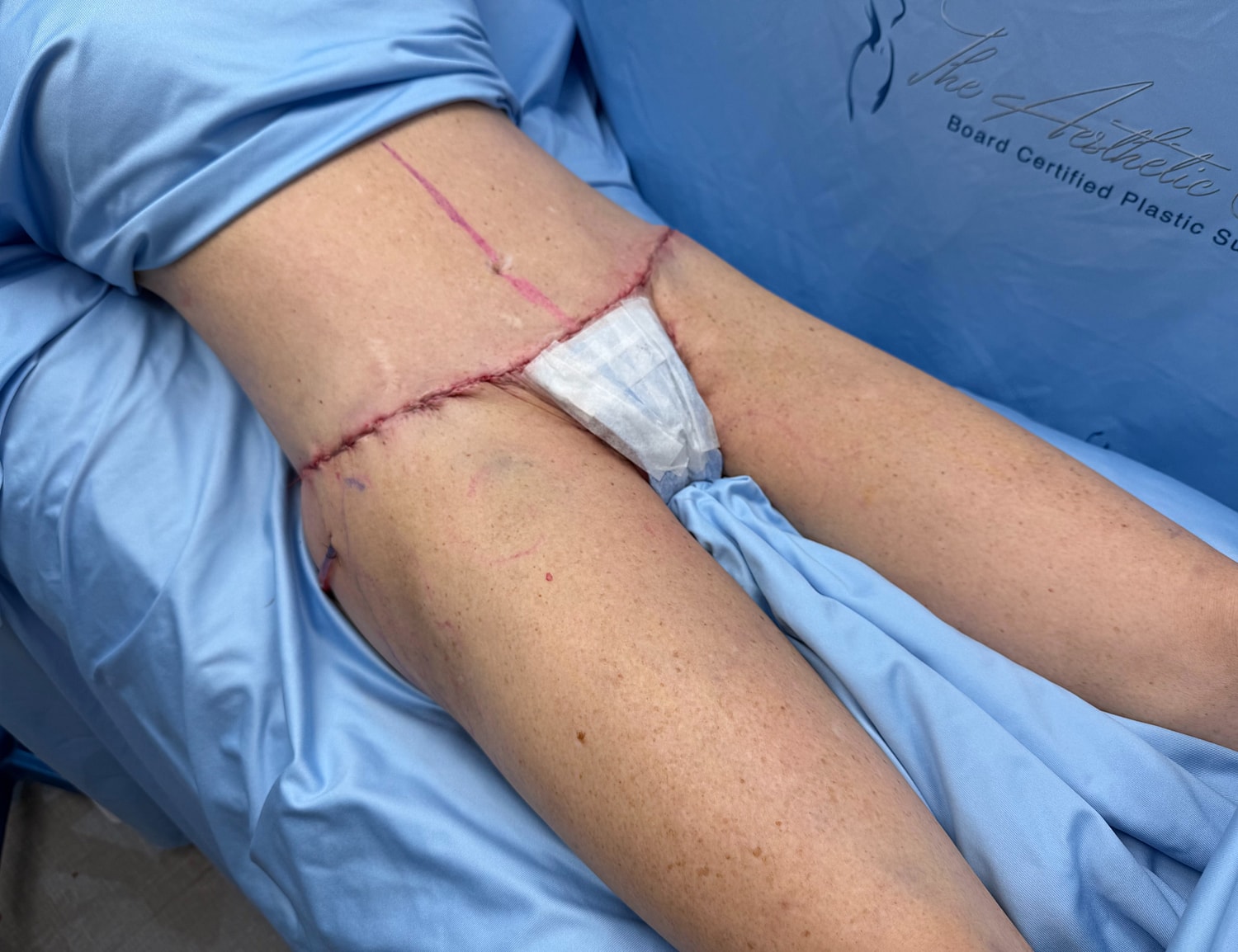 Post-surgery recovery with stitches on abdomen.