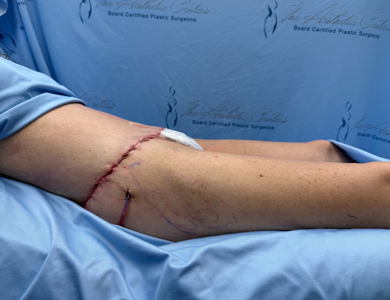 Surgical incision on a patient's arm.