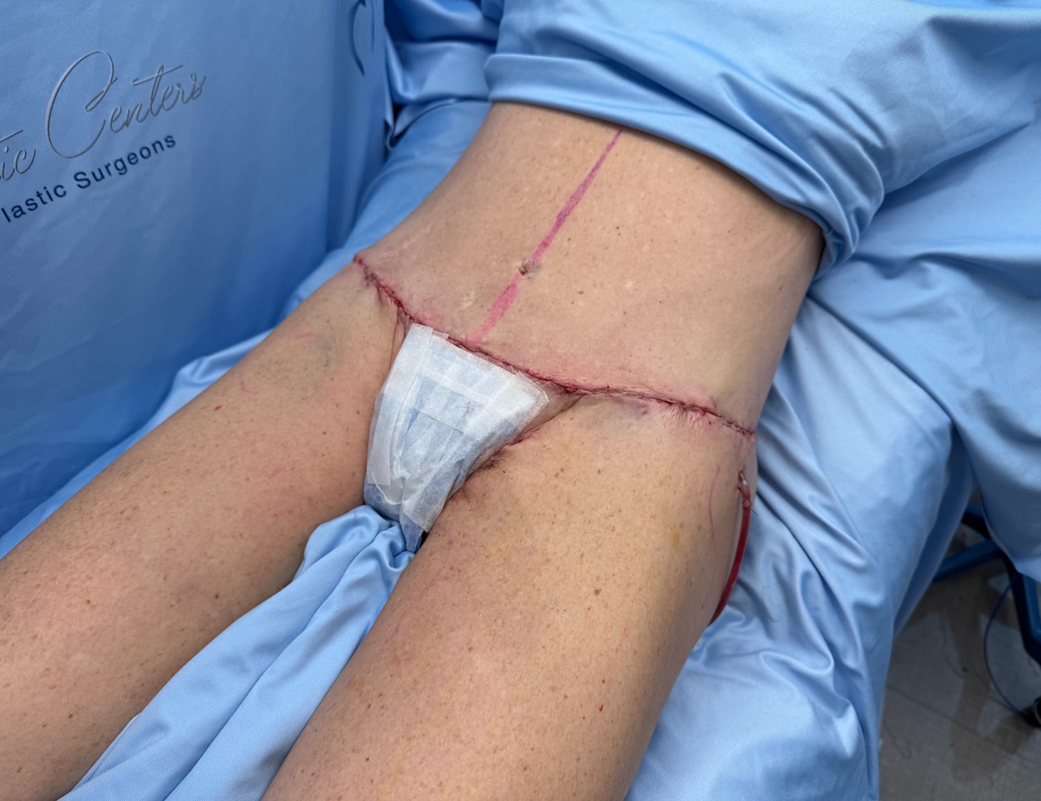 Surgical incision on lower abdomen post-operation.