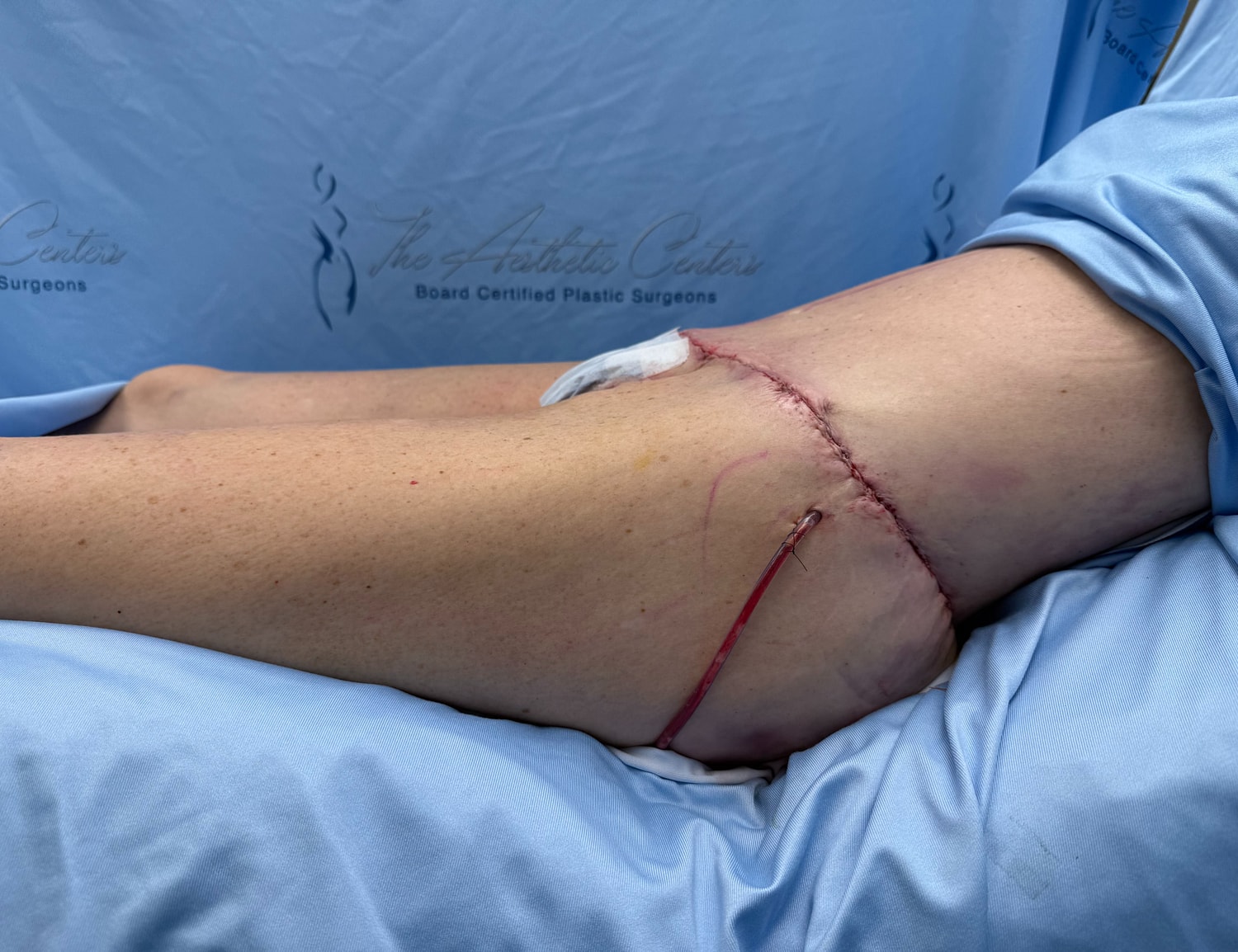 Surgical wound on a patient's thigh.