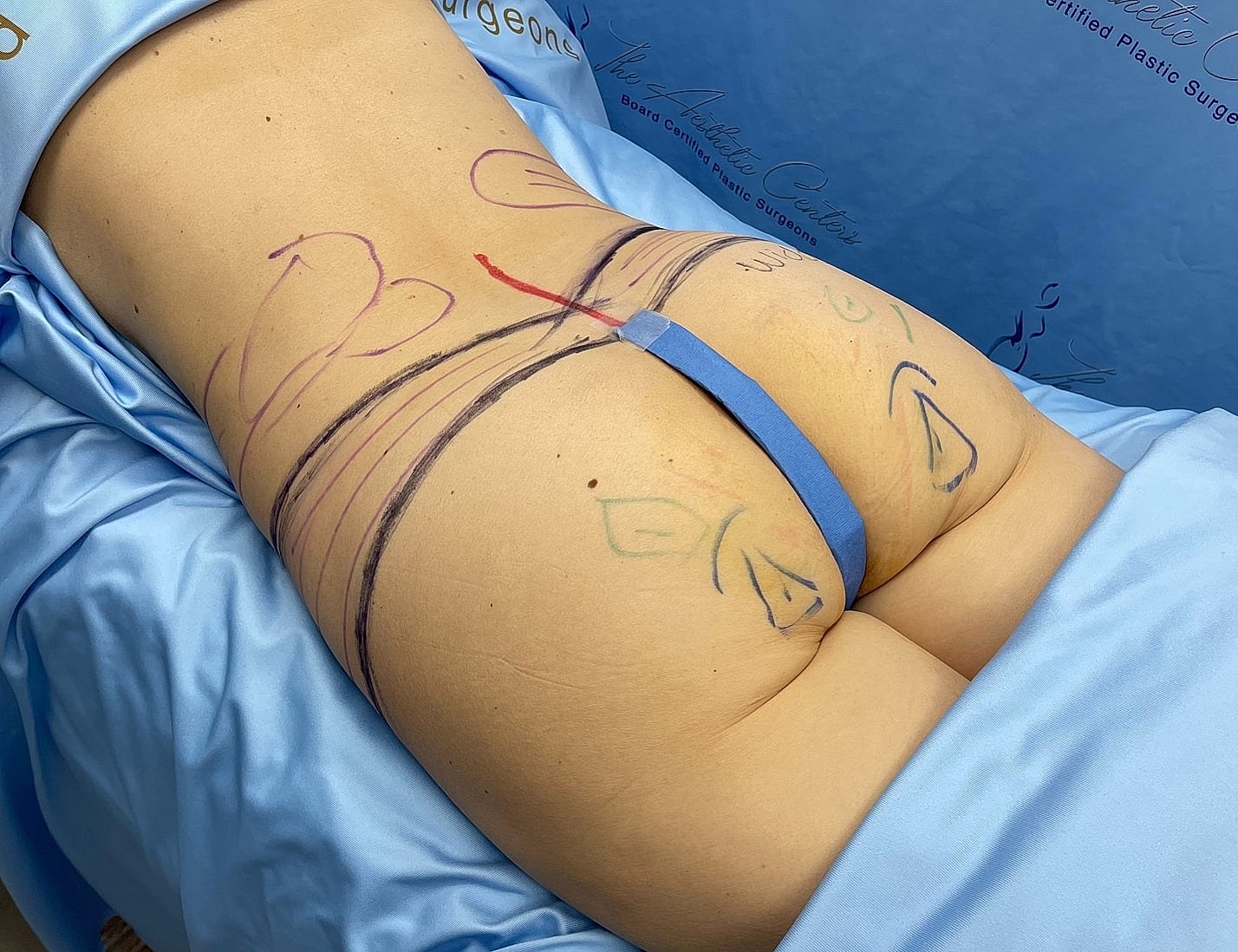 Body contouring markings on a surgical patient.