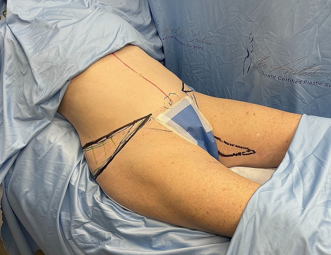 Patient prepared for surgery with markings on skin.