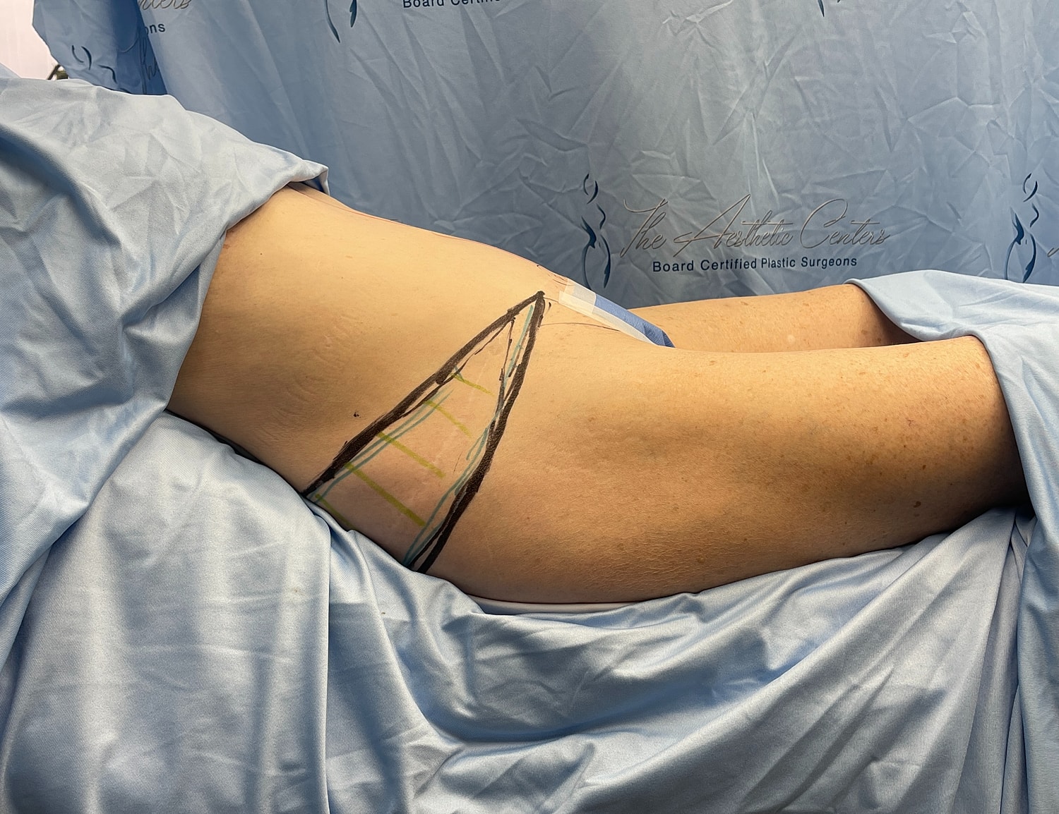 Surgical markings on patient’s side before procedure.