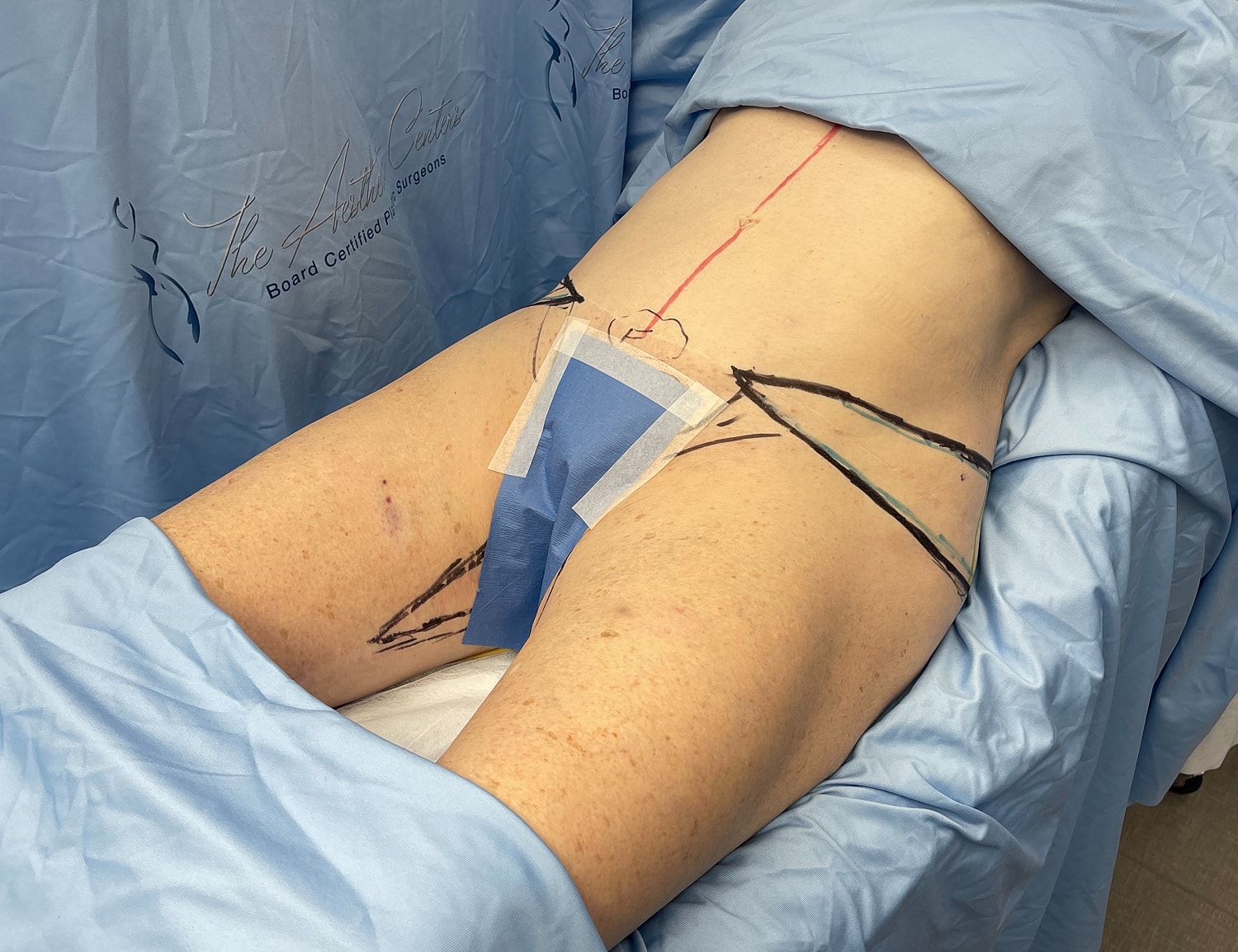 Surgical markings on patient before procedure.