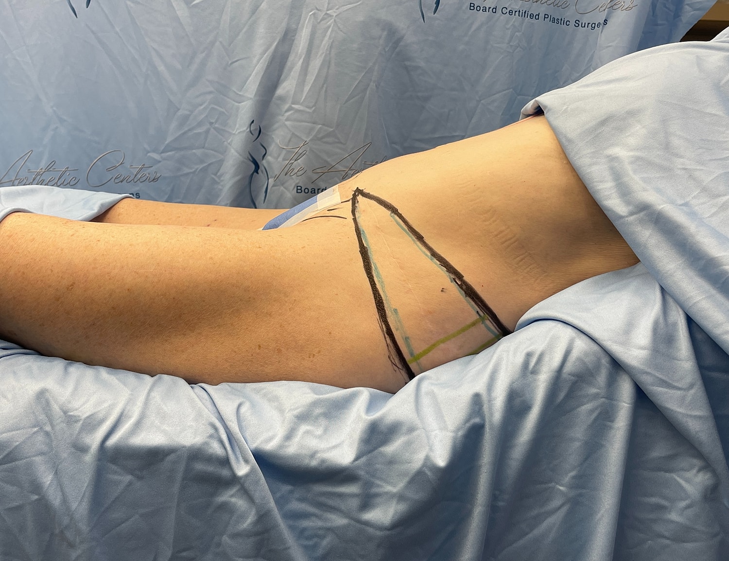 Surgical markings on a patient's side before procedure.