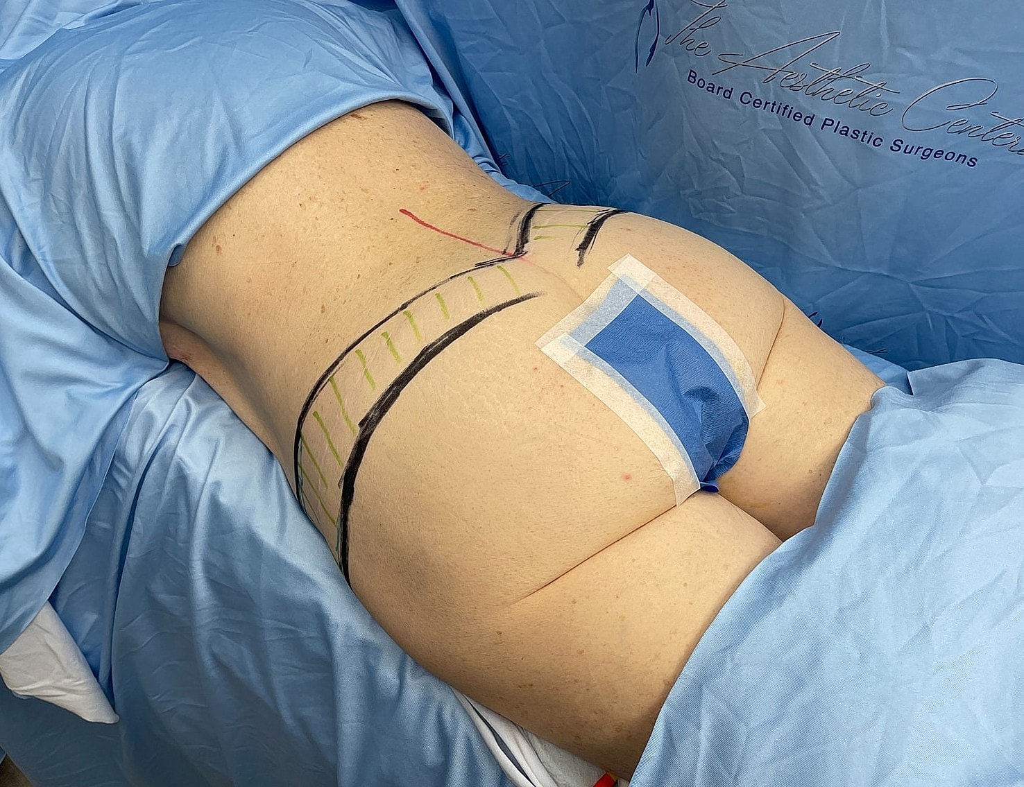Patient preparation for cosmetic surgery procedure.