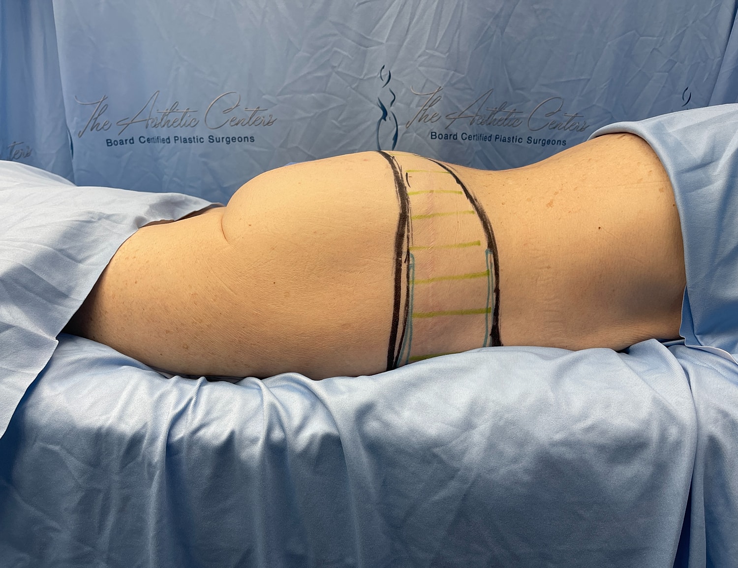 Patient preparation for body contouring procedure.