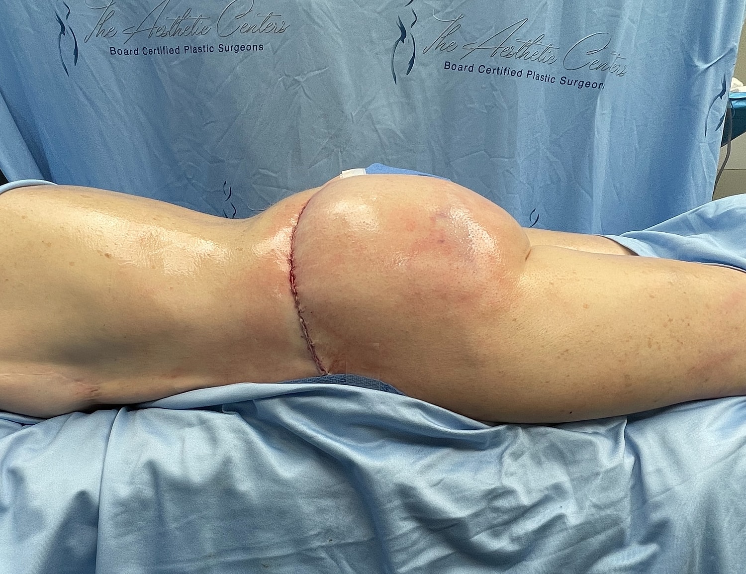 Post-surgery buttock enhancement with visible incision.