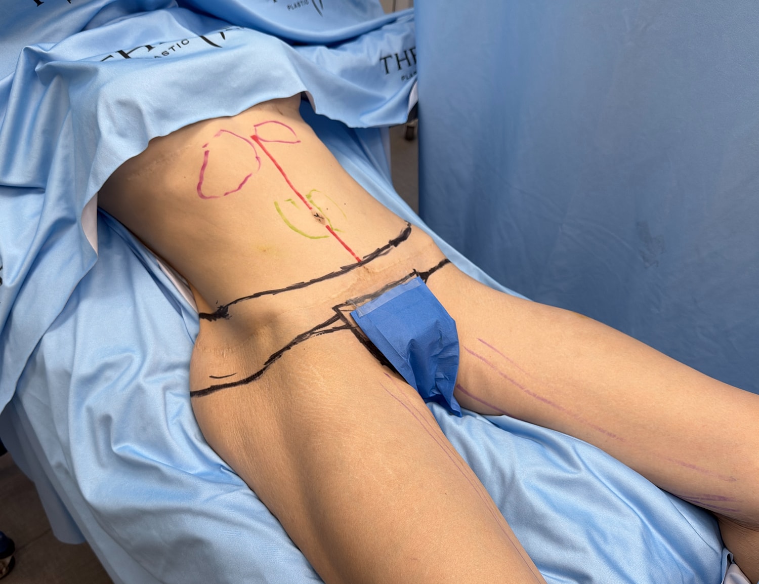 Pre-operative markings on patient's abdomen.