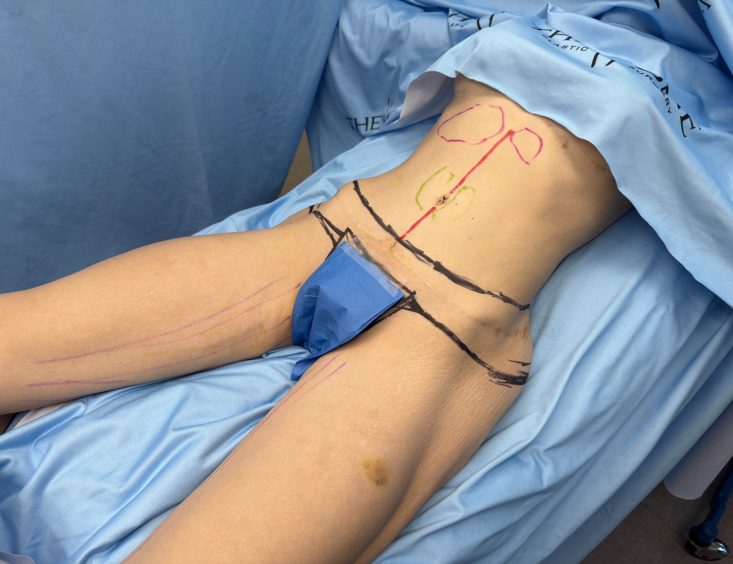 Surgical markings on a patient's abdomen and thighs.