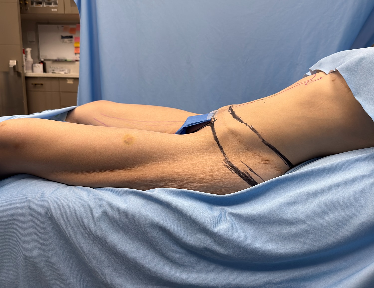 Patient's leg marked for surgical procedure preparation.