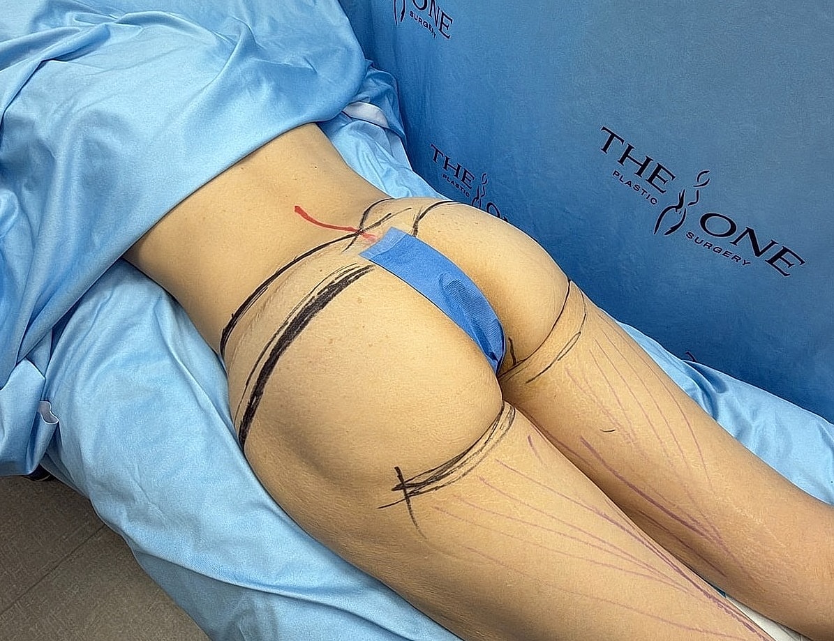 Patient prepared for cosmetic surgery procedure.