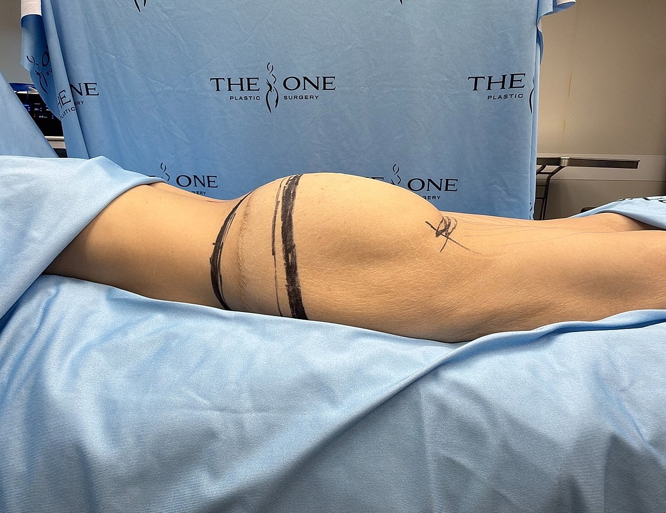 Surgical preparation with markings on patient’s body.