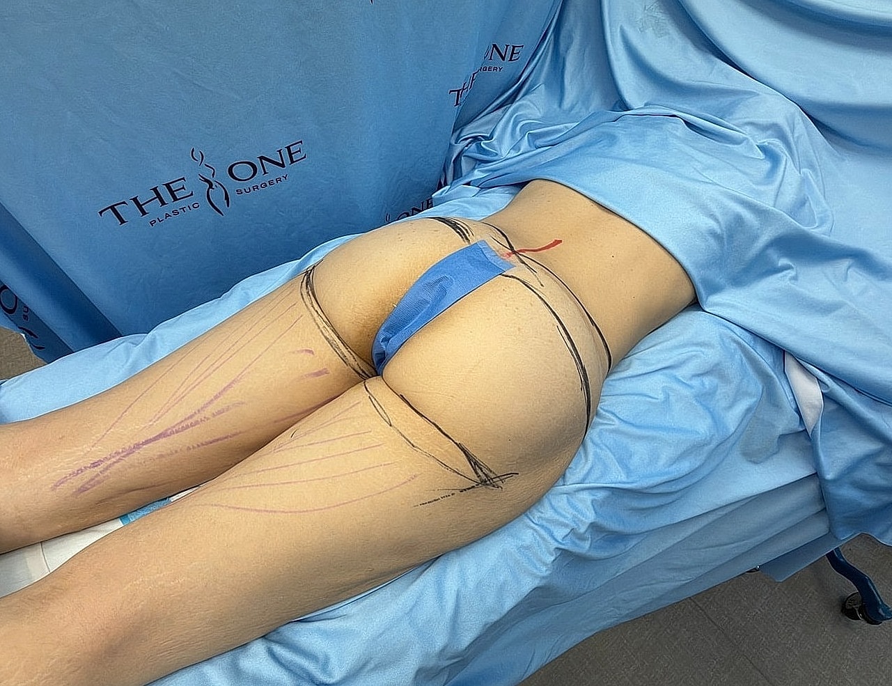 Patient preparation for surgical procedure on lower body.