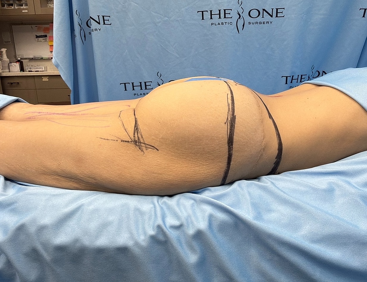 Patient preparing for cosmetic surgery procedure.