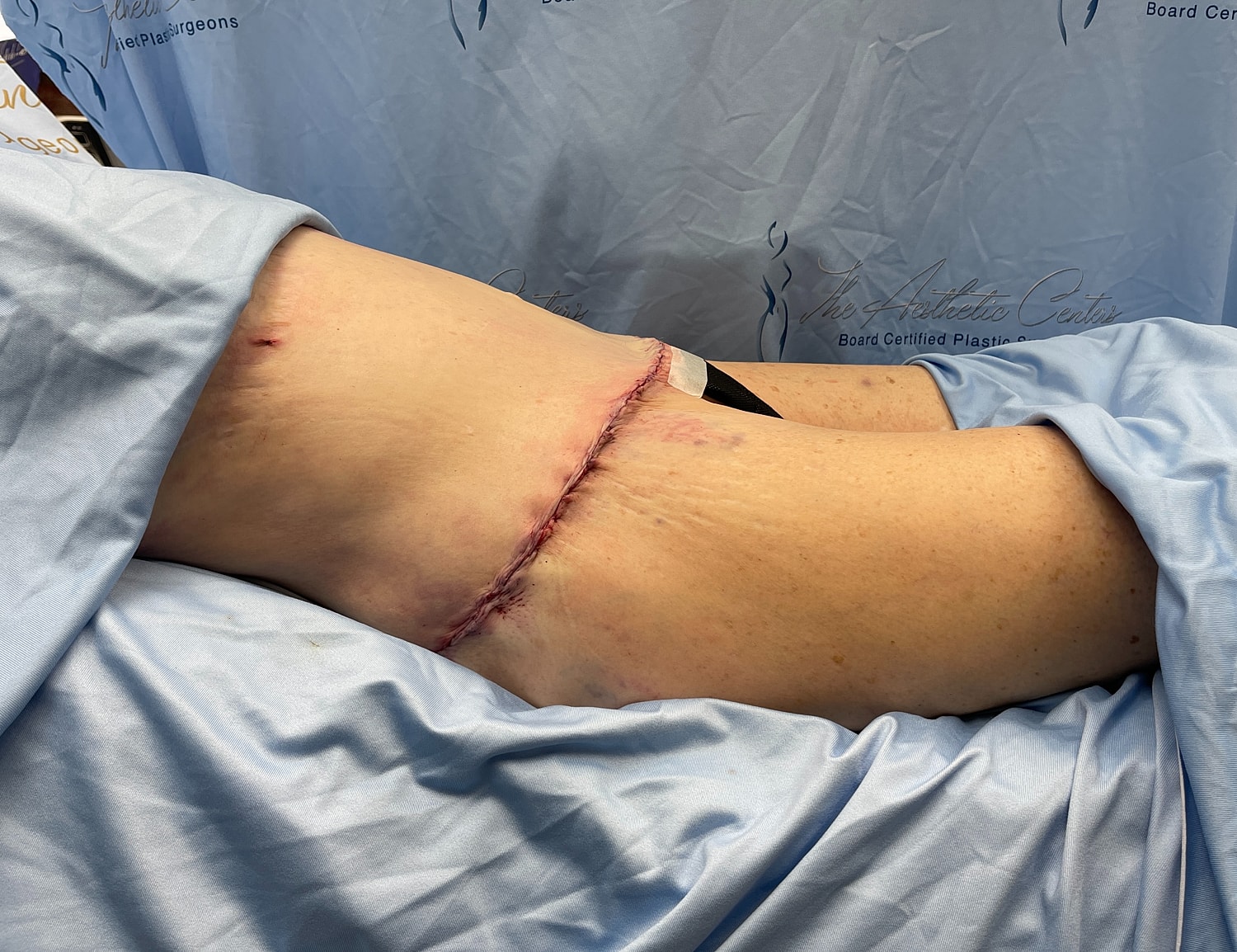 Surgical incision on patient's hip post-procedure.