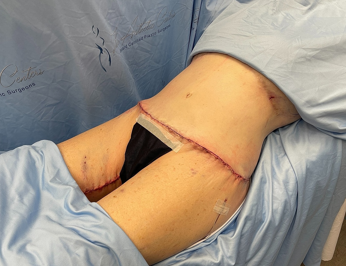 Surgical incision on a patient’s torso.