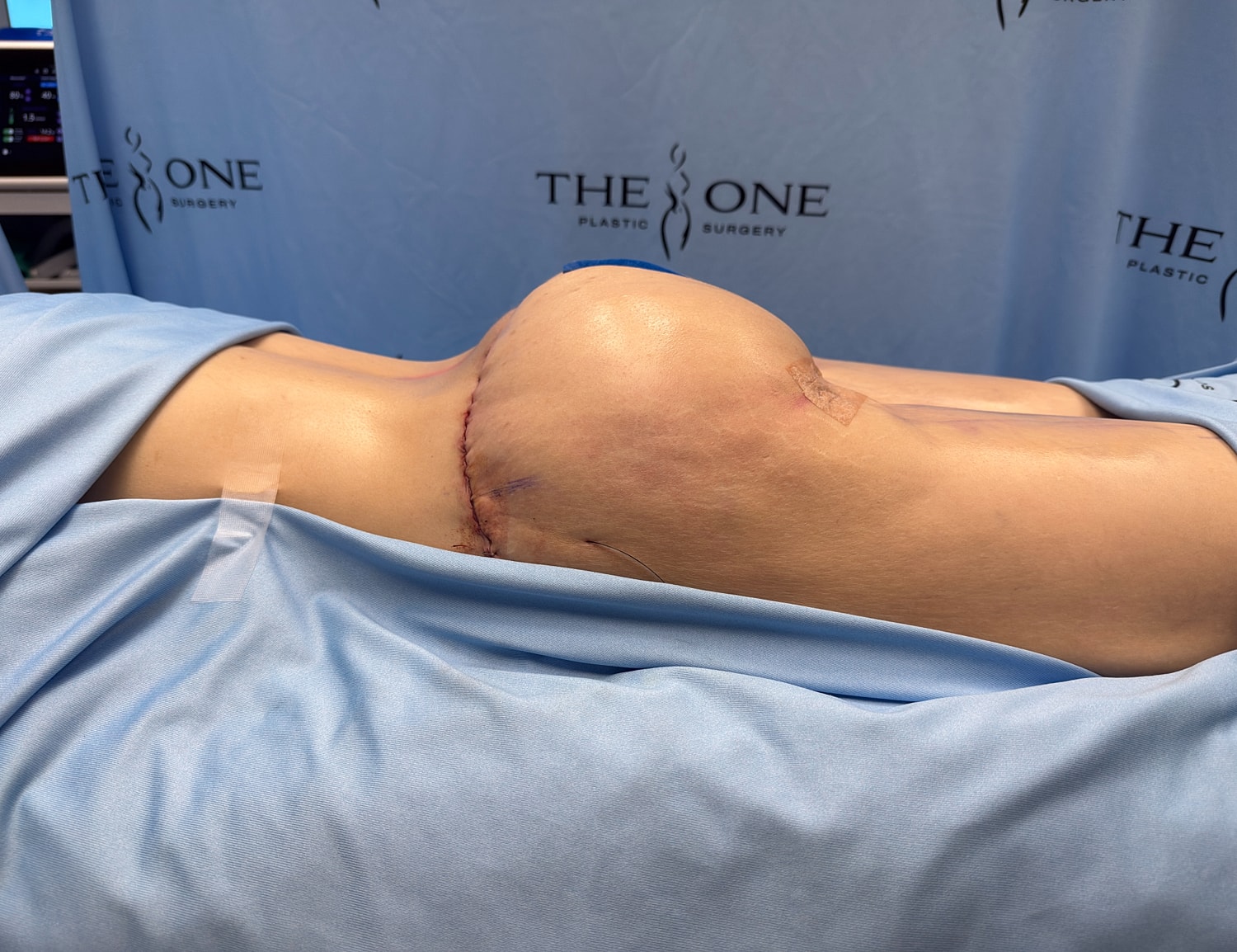 Post-surgery body contouring procedure.