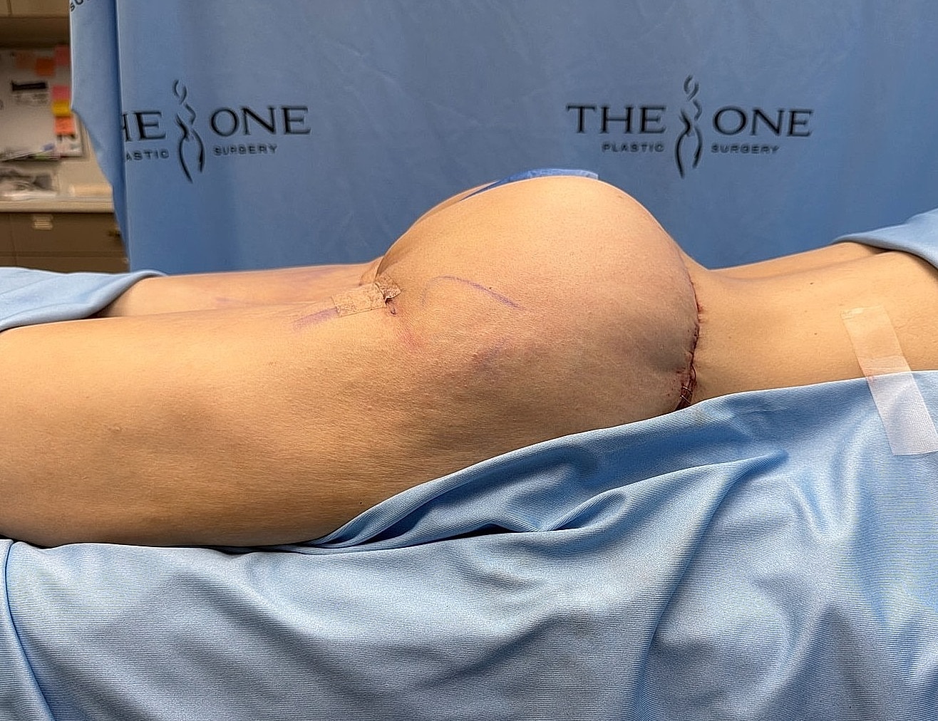 Post-surgery recovery with visible stitches on leg.