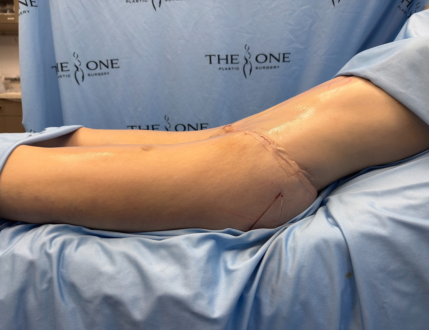 Patient with surgical incision on thigh.