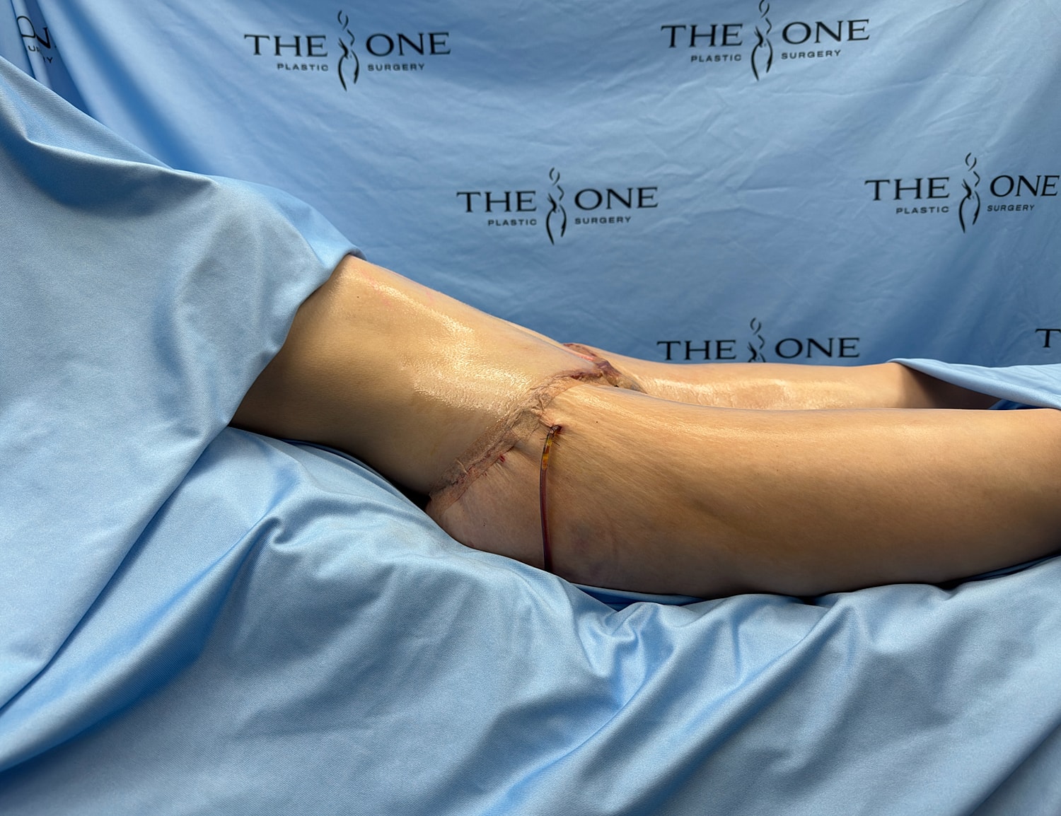 Surgical incision on a patient's leg.
