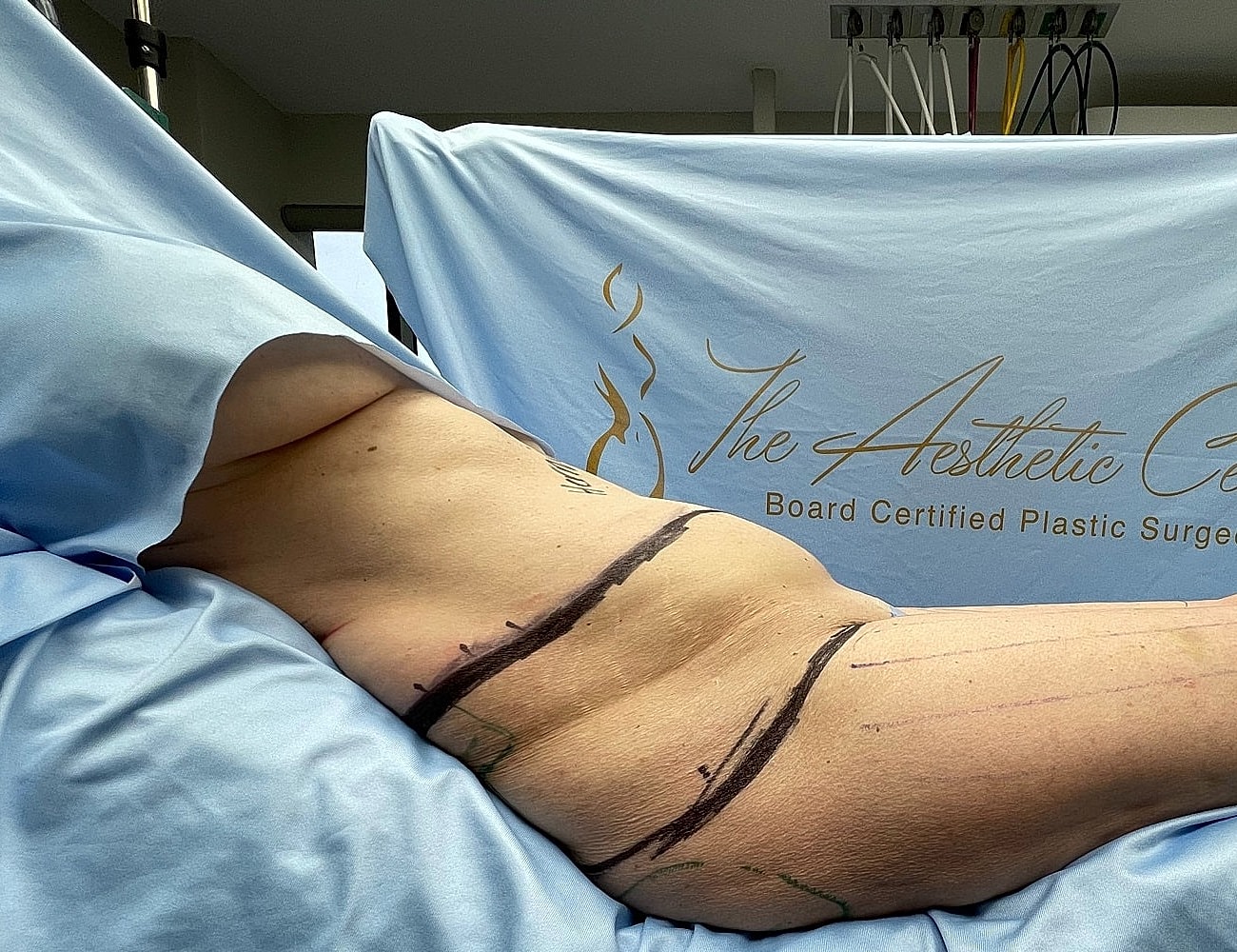 Surgical markings on patient in medical setting.