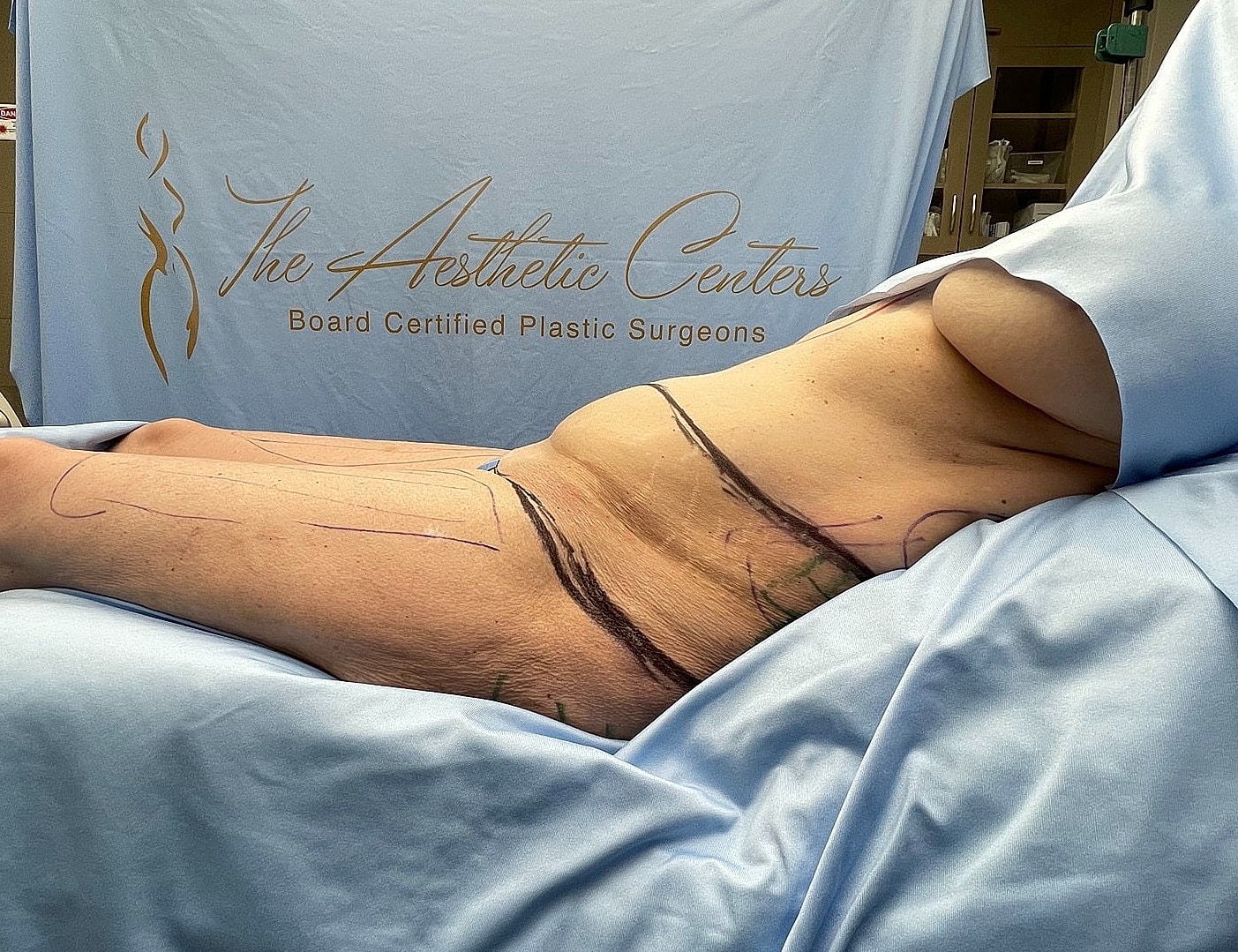 Patient preparation for aesthetic surgical procedure.