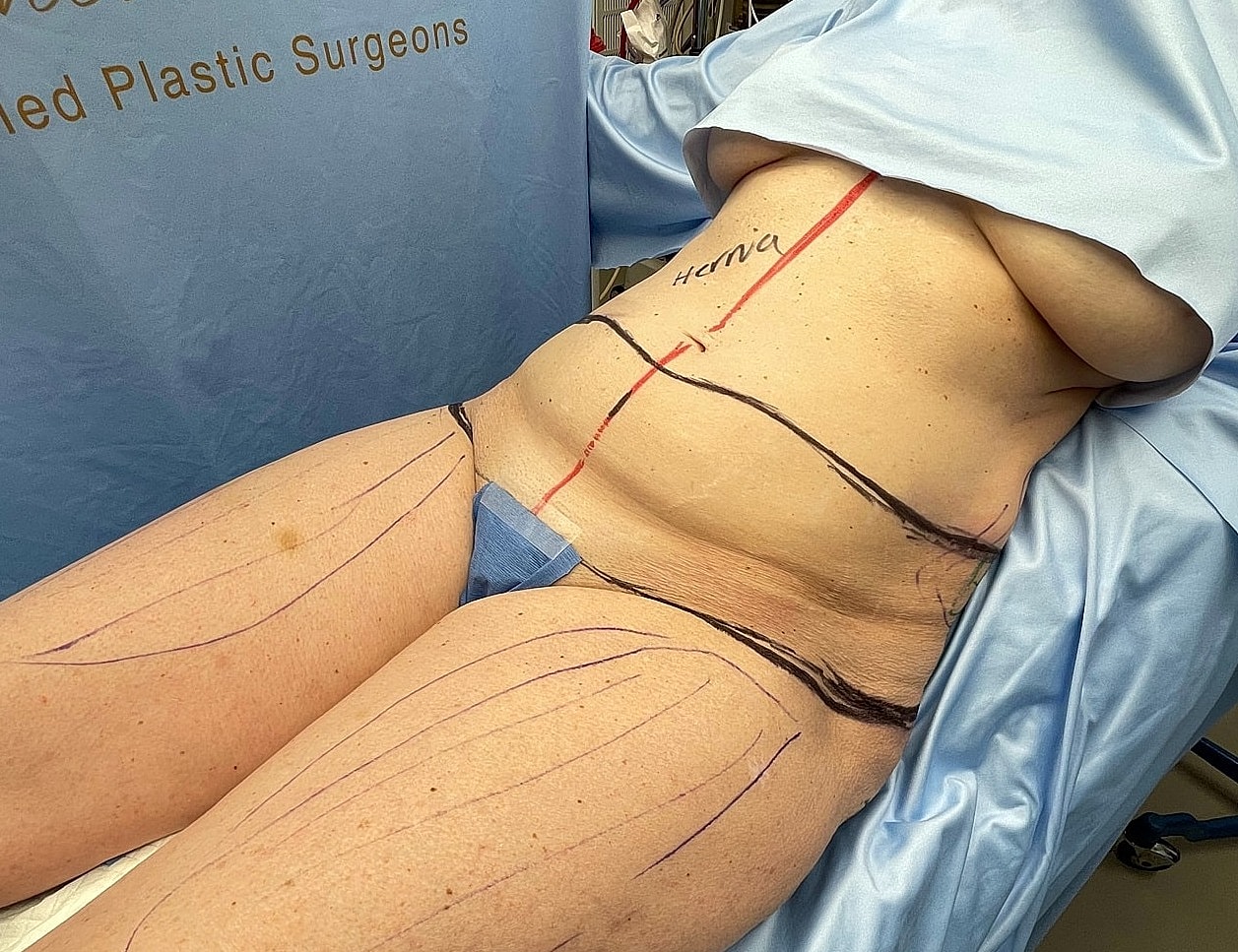 Patient preparing for cosmetic surgery with markings.