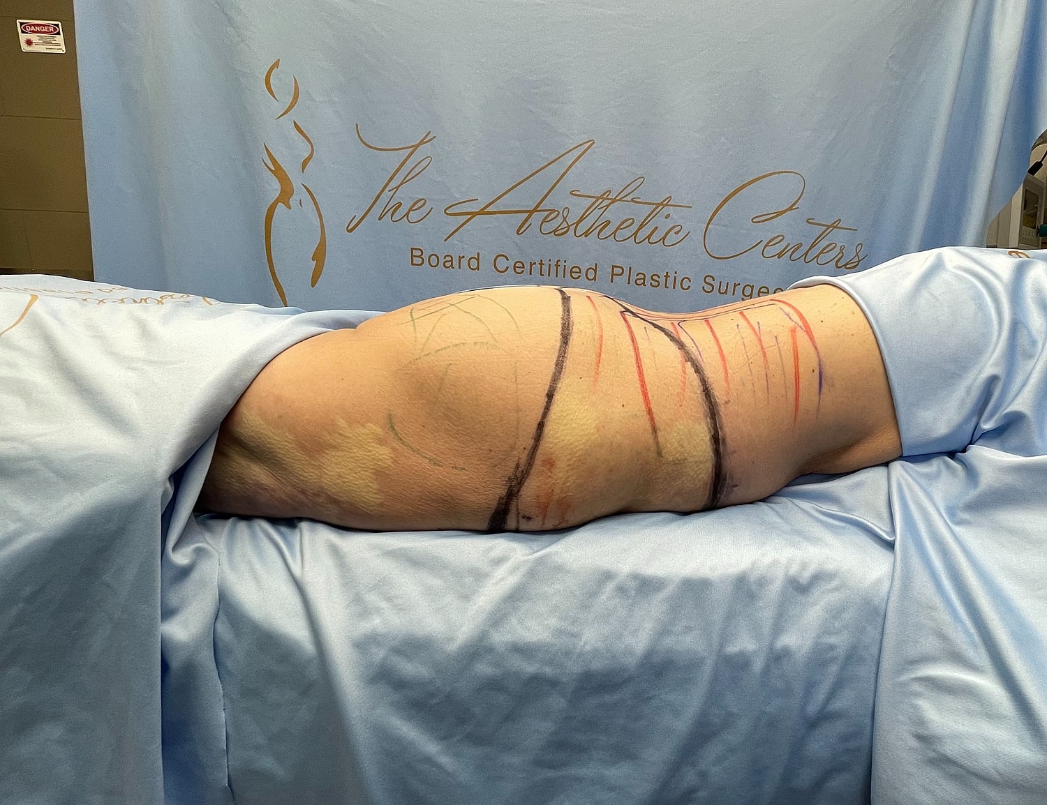 Patient preparation for plastic surgery procedure.