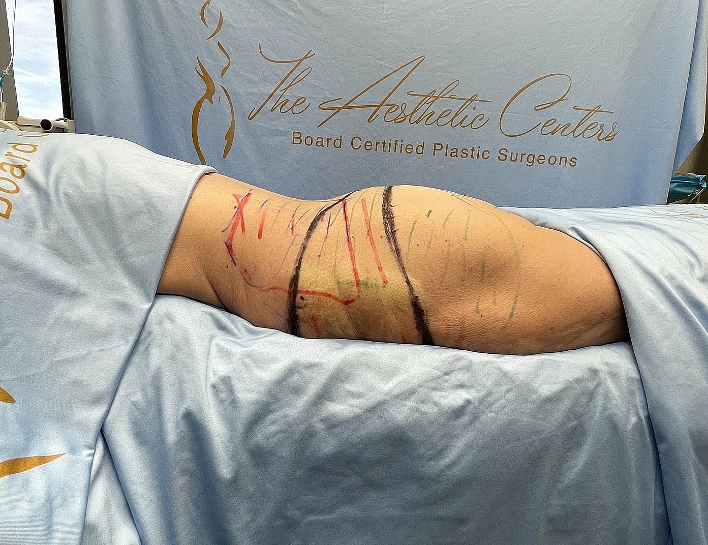 Patient marked for aesthetic surgery procedure preparation.