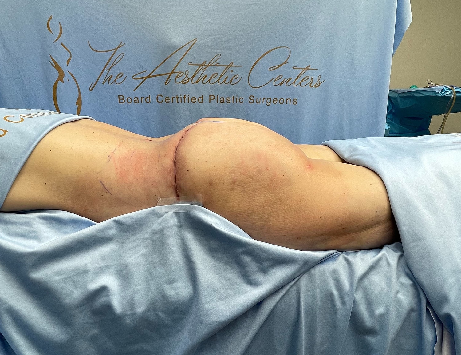 Surgical procedure at aesthetic clinic environment.