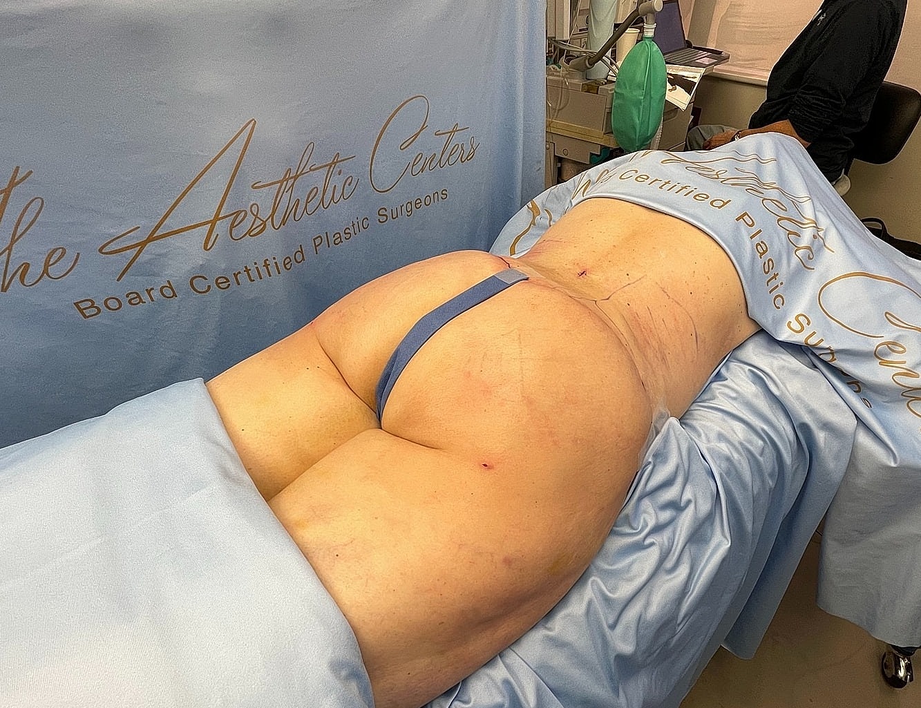 Patient preparing for plastic surgery procedure.