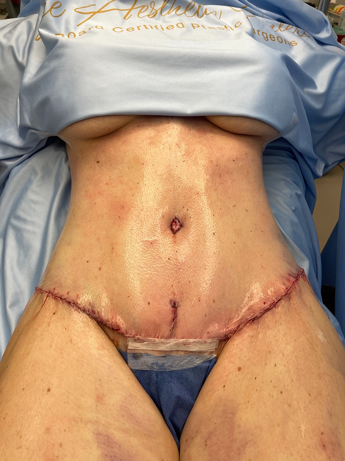 Post-surgery abdomen with visible sutures and scars.