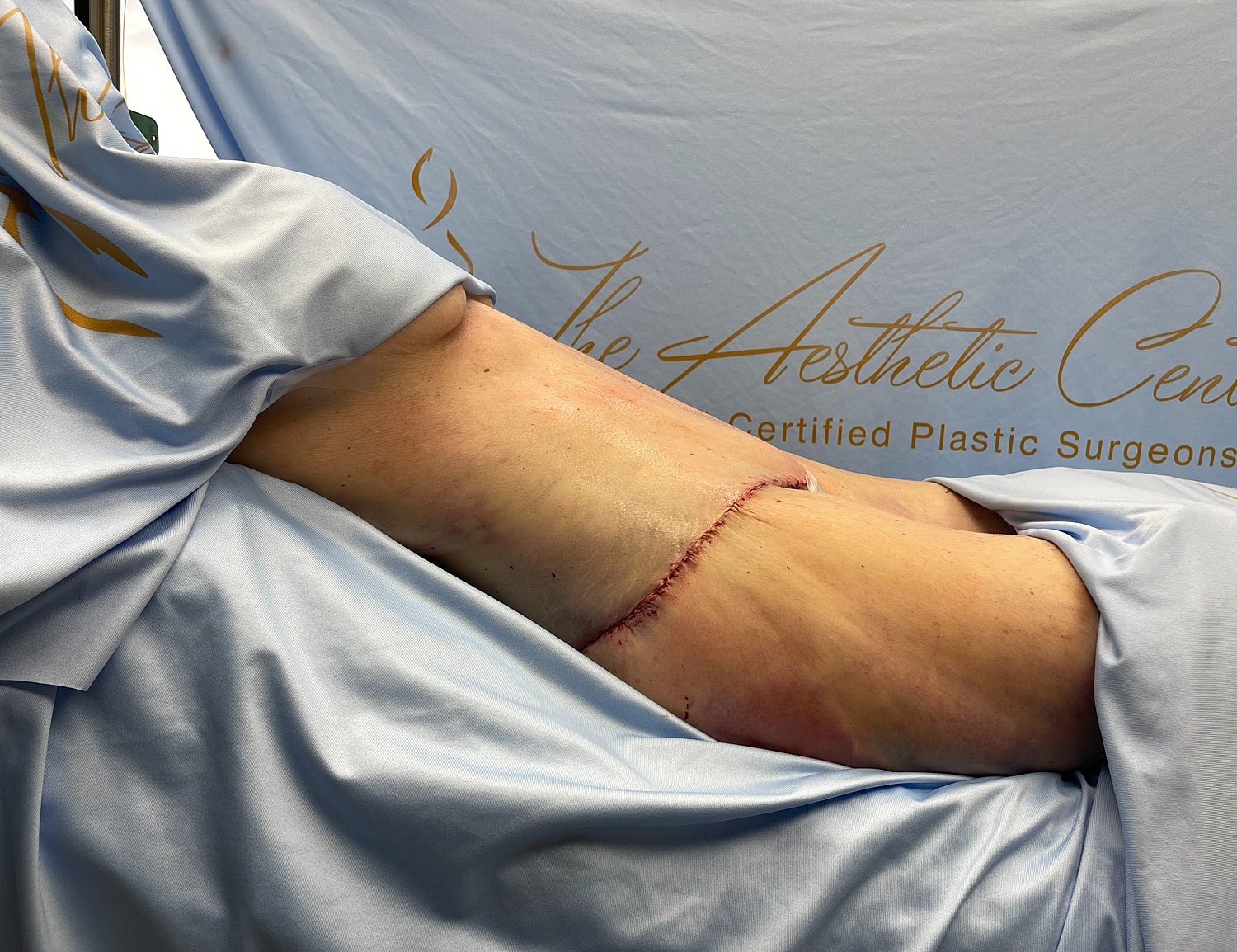 Surgical site with visible incision on leg.