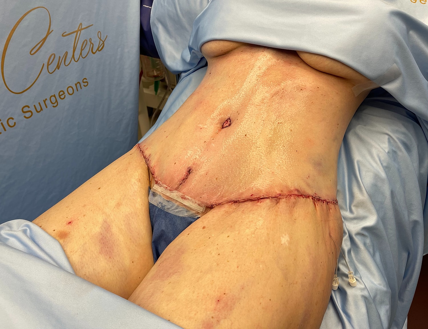 Post-surgery view of stitched abdomen area.