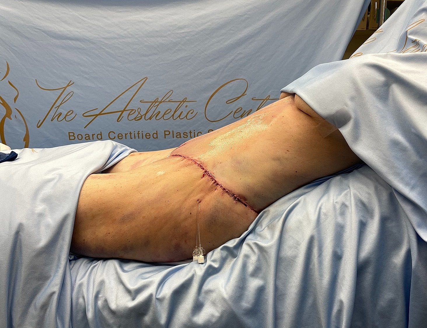 Patient post-operative incision on abdomen.