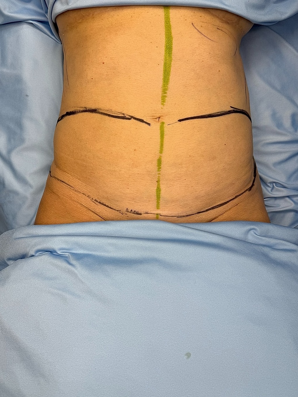 Marked abdomen preparing for a surgical procedure.