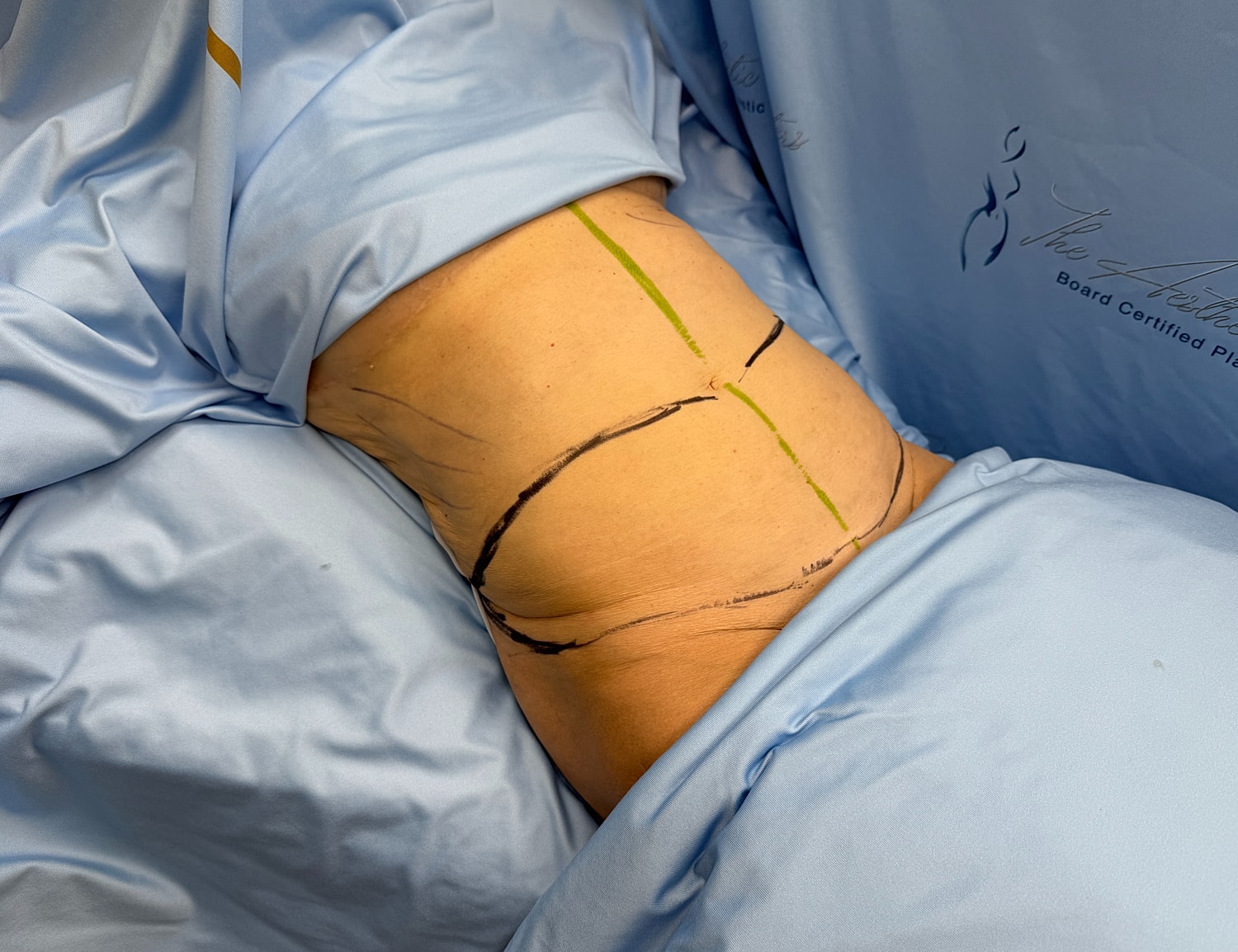 Body marking for surgical procedure on torso.