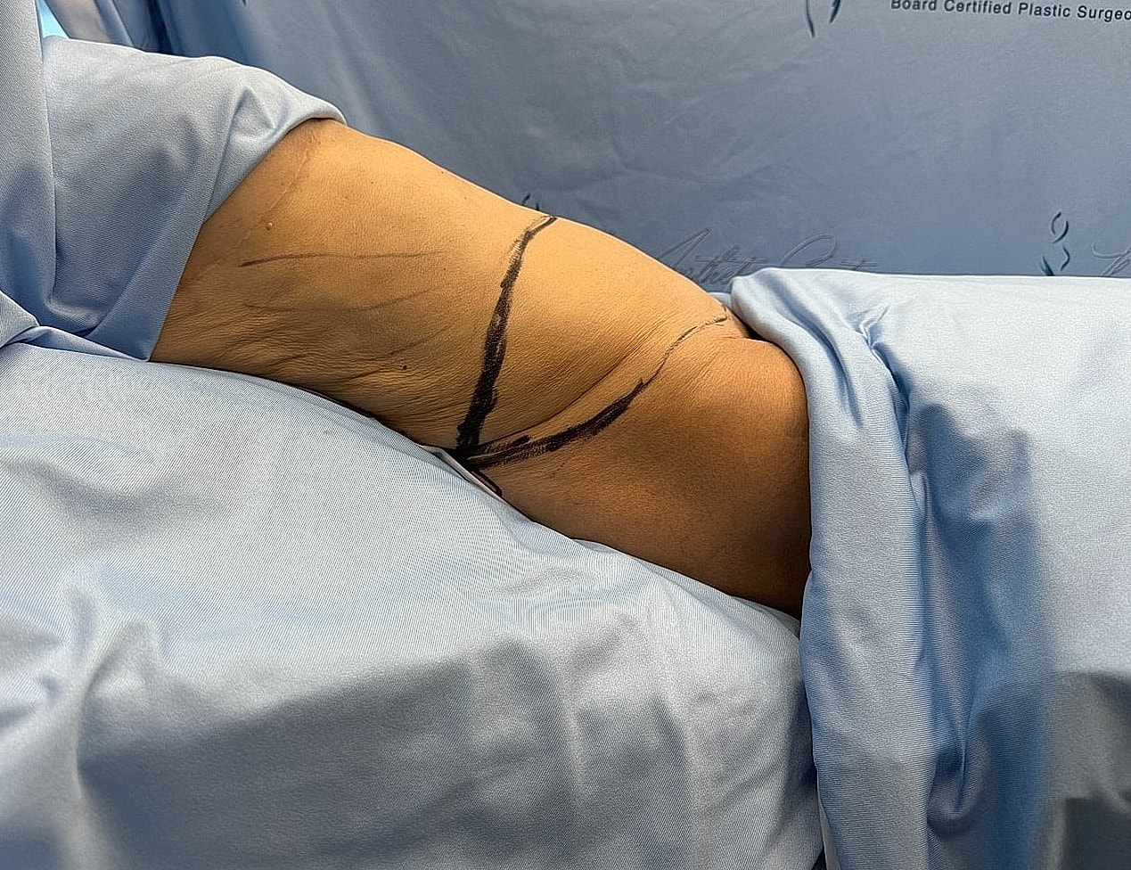Arm marked for surgical procedure, blue drapes.
