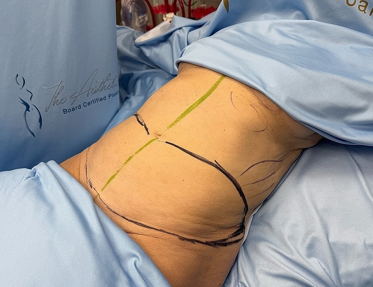 Body contouring markings on patient before procedure.